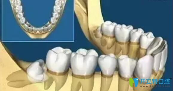 阻生牙拔除多少錢？先看看阻生智齒拔除難度有多大