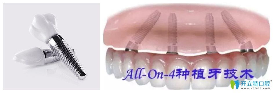 美奧口腔allon4半口牙種植價格圖