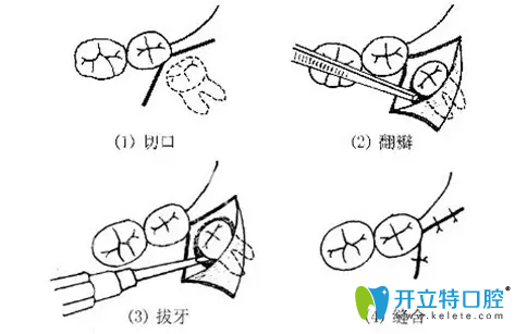 阻生牙治療方法