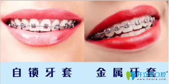 重慶美奧口腔金屬托槽正畸圖