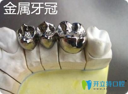 金屬牙冠