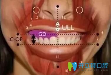 肌肉因素導(dǎo)致的露齦笑