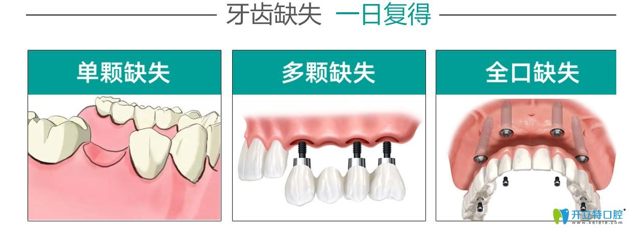種植牙適合哪種口腔問題