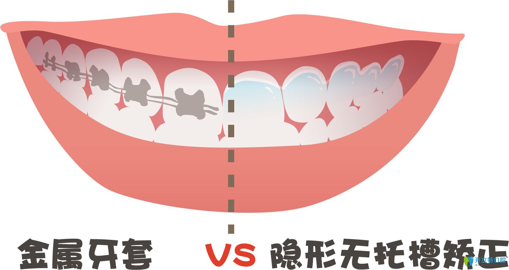 金屬牙套和隱形托槽矯正