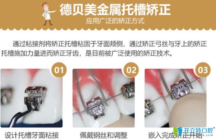 德貝美口腔牙齒矯正特色技術之金屬托槽矯正