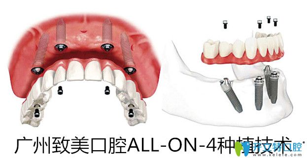 <!--<i data=20240703-sp></i>-->口腔allon4半口種植技術(shù)
