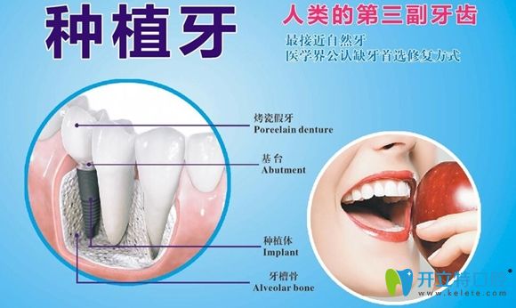 邁兔口腔半口種植牙更優(yōu)惠