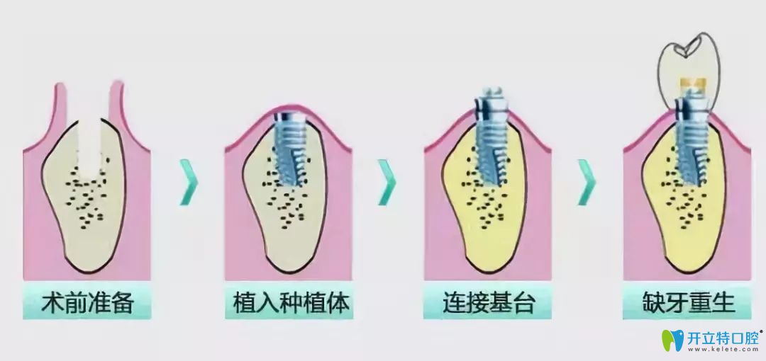 種植牙流程