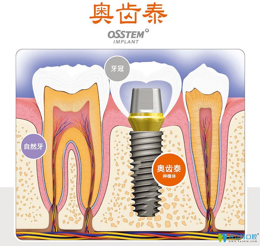 韓國奧齒泰種植系統(tǒng)