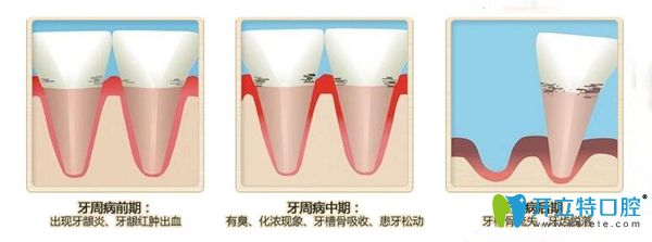 牙周病不同時(shí)期的癥狀
