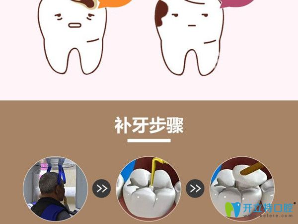 牙醫(yī)解析補牙用什么材料好，選卡瑞斯瑪樹脂補牙還是3m好？