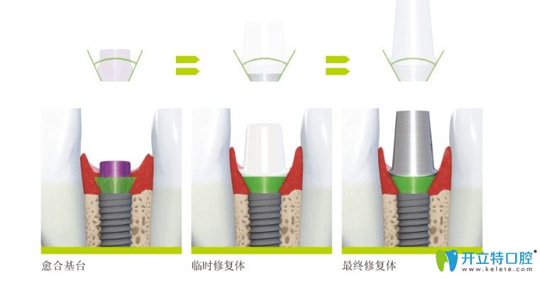 什么是骨水平種植體