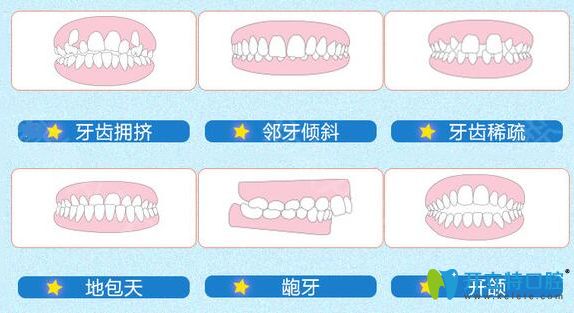 需要做牙齒矯正的一些圖片