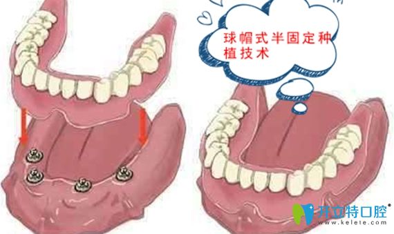 半固定種植牙修復(fù)示意圖