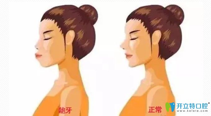 廣州齙牙矯正哪個醫(yī)院好？隱形矯正可以解決齙牙問題嗎？