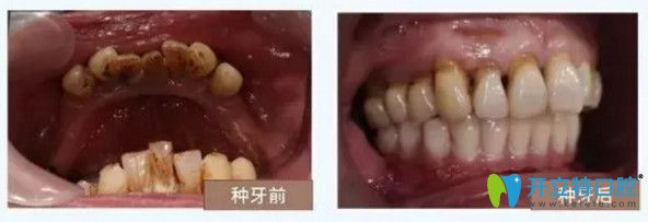 南寧柏樂口腔種植牙對(duì)比圖