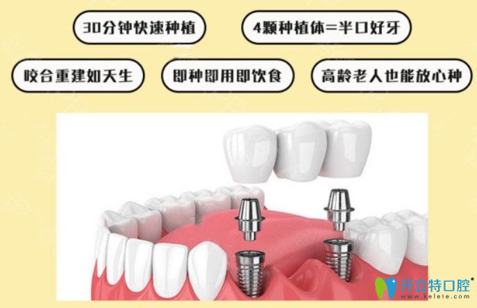 即刻種植牙優(yōu)缺點(diǎn)