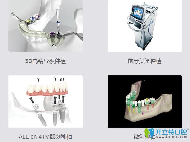重慶美奧口腔4大種植技術