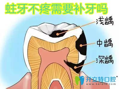 主要不疼不補(bǔ)牙可以嗎