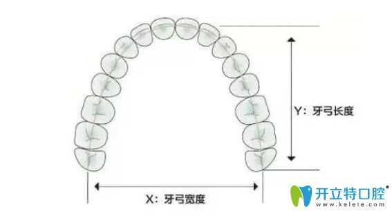 李可君醫(yī)生給科普牙齒矯正的擴(kuò)弓器有什么作用