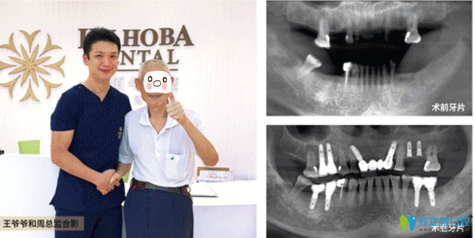 東莞好佰年口腔即刻種植牙對比