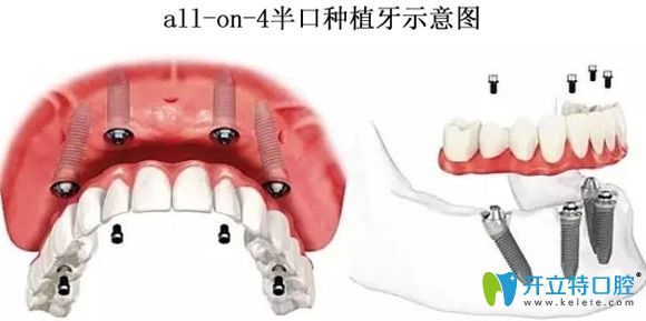 all-on-4半口種植牙示意圖