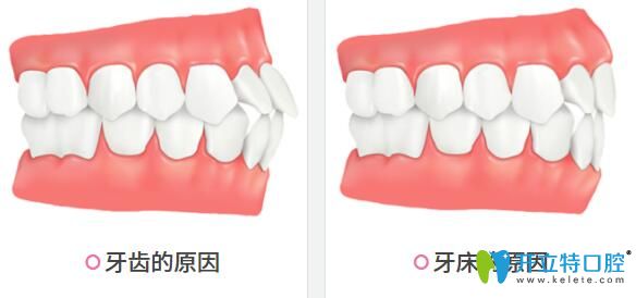 牙性齙牙和骨性齙牙
