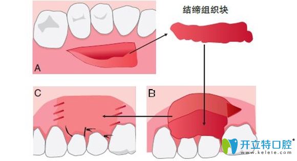 牙齒修補(bǔ)手術(shù)過程圖解