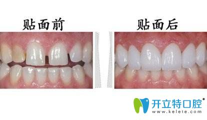 牙齒貼面前后對比
