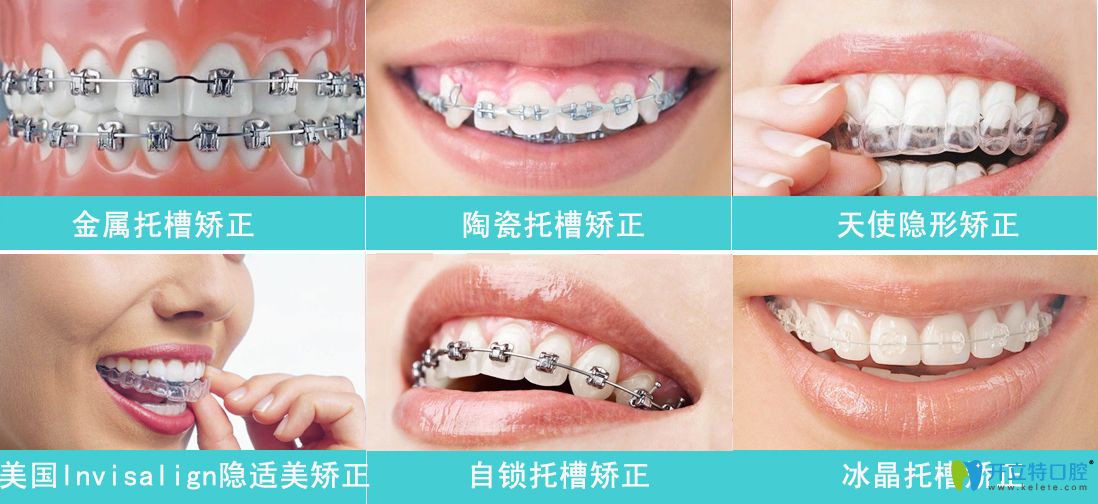 牙齒矯正種類