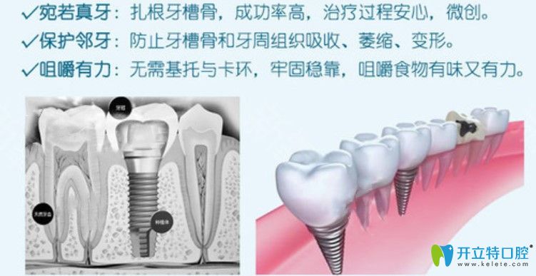 <!--<i data=20240703-sp></i>-->口腔的即刻負(fù)重種植牙技術(shù)