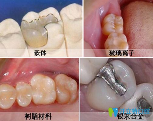 從補牙鑲牙和種牙區(qū)別看哪個好,種牙滿口多少錢看看all-on-4