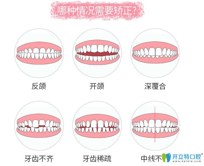 哪些牙齒畸形要進行牙齒矯正