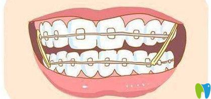牙齒矯正的原理是什么 牙齒矯正的原理是什么