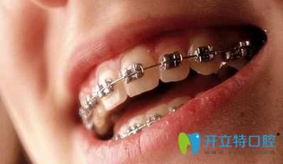 德貝口腔傳統(tǒng)金屬托槽矯正 德貝口腔傳統(tǒng)金屬托槽矯正