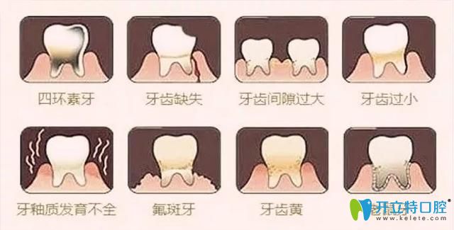 適合做牙齒貼面的一些情況