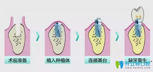 即刻種植牙