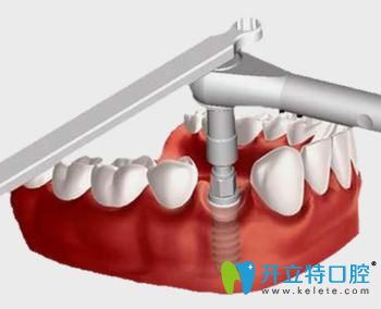 寧波恒美口腔王敬彬即刻負(fù)重種植牙好處