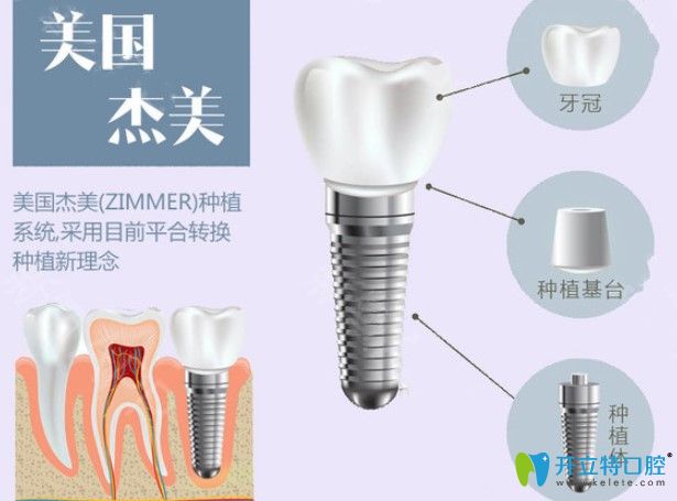 美國zimmer種植體特點(diǎn)