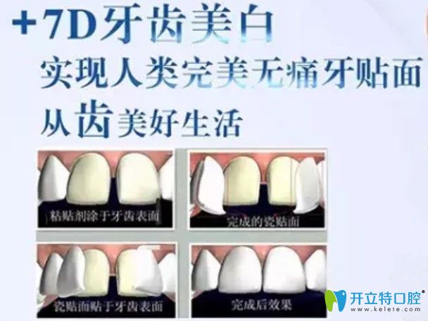 黃仁輝醫(yī)生告訴你7D牙齒美白技術(shù)是什么
