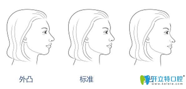 牙齒畸形不同程度對比圖