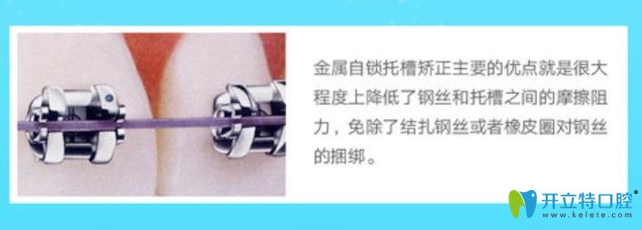 美國(guó)AO自鎖托槽矯正圖示