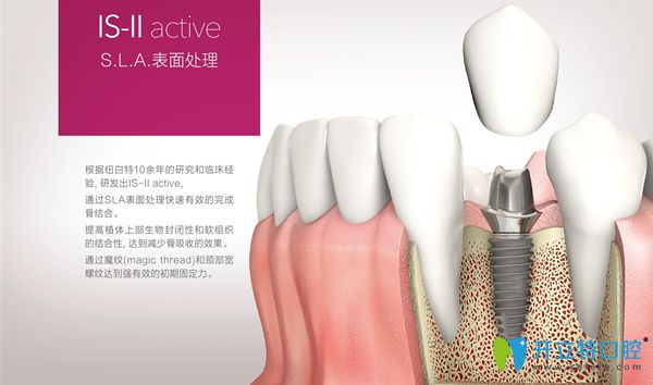 韓國neo種植體簡介