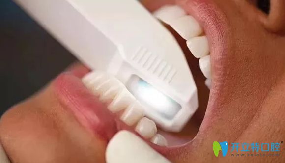 使用時代天使口掃儀過程圖