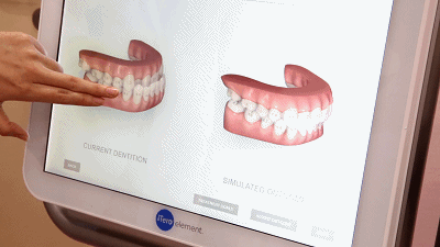 天津美奧口腔牙齒矯正口掃設(shè)備