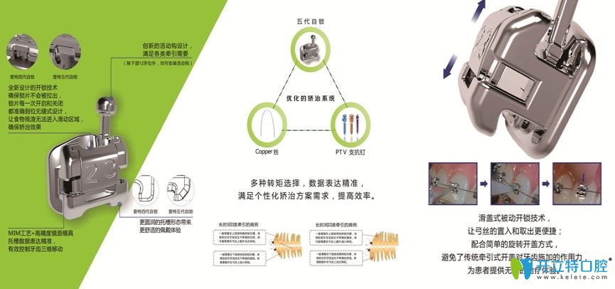 普特五代托槽優(yōu)勢