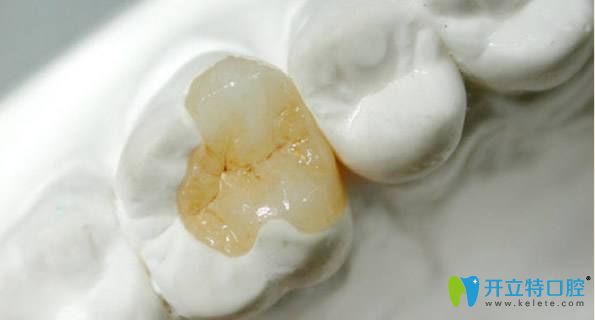 補(bǔ)牙的另一種方法——嵌體 補(bǔ)牙的另一種方法——嵌體