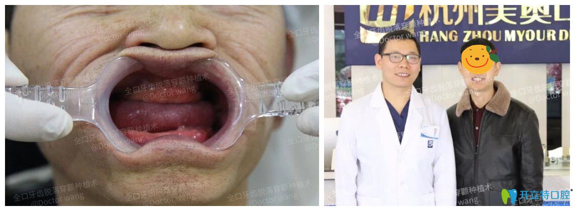 黃先生全口牙齒缺失在美奧做了穿顴種植真實(shí)案例分享