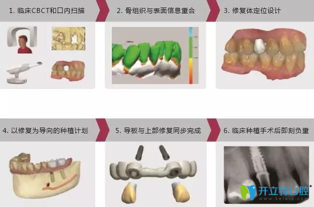 數(shù)字化導(dǎo)板導(dǎo)航種植技術(shù)過(guò)程
