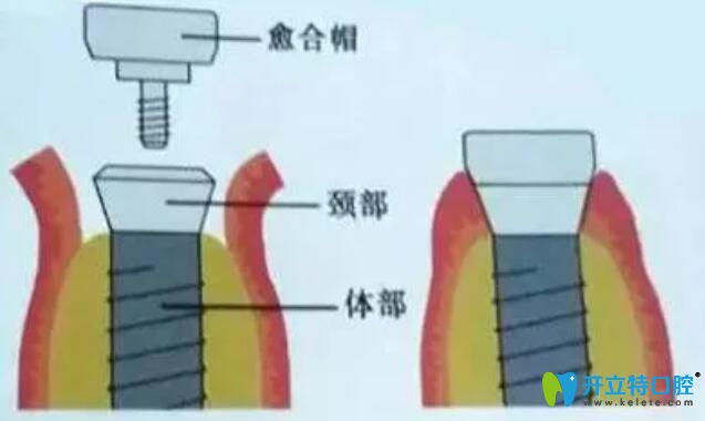 非埋入式種植